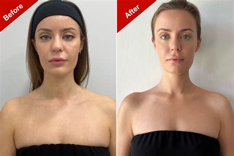 Trap botox before and after. Things To Know About Trap botox before and after. 